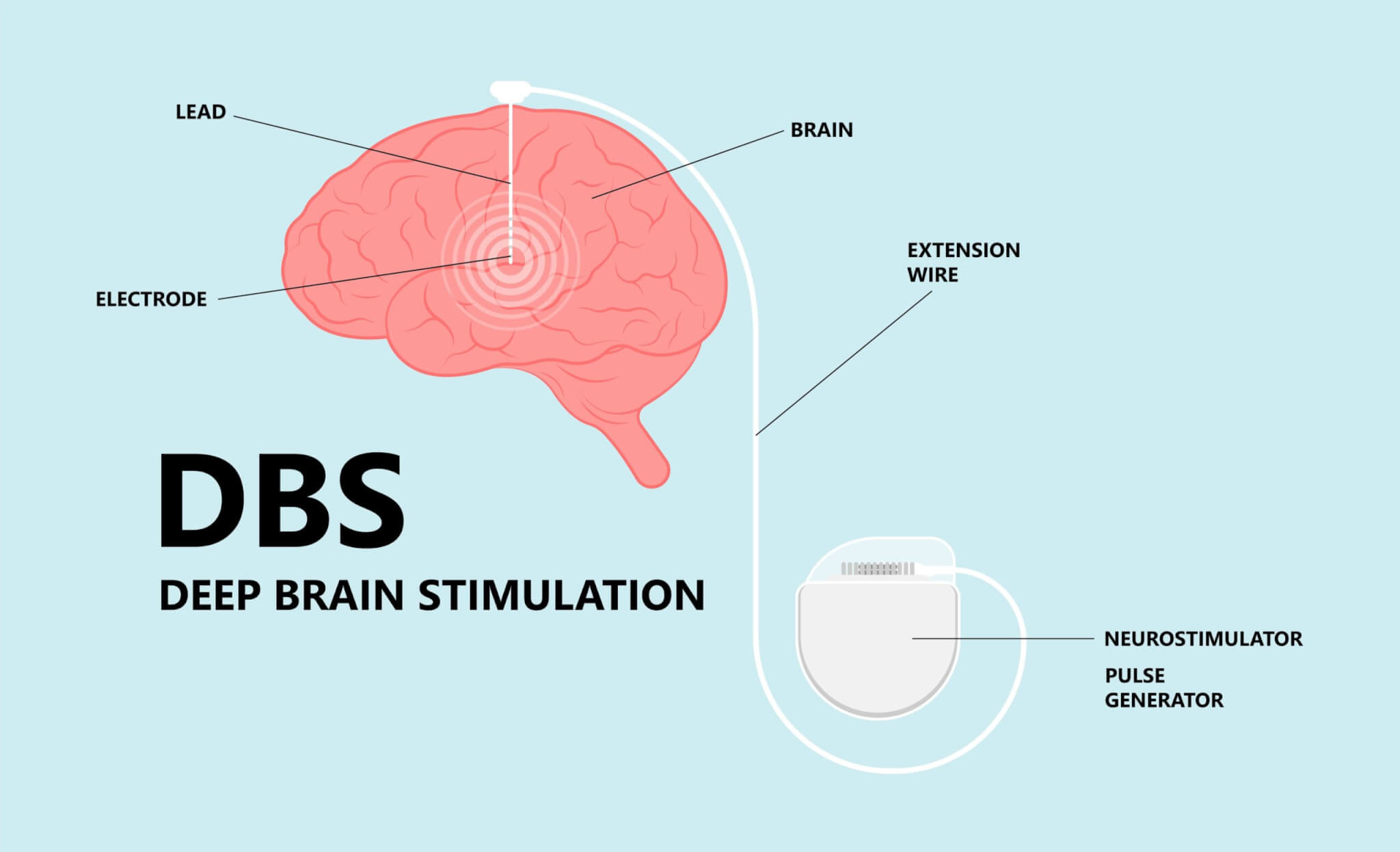 Deep brain stimulation or DBS