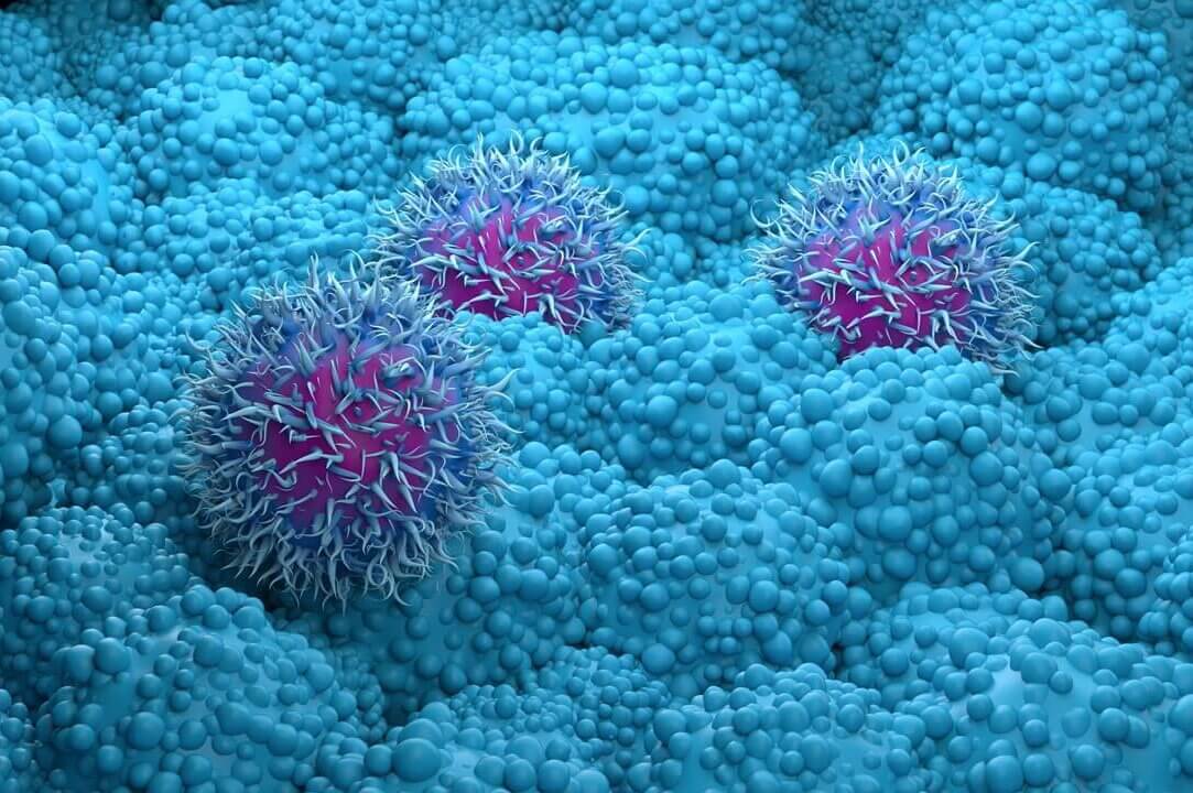 Adobe Stock image of pancreatic cancer cells.