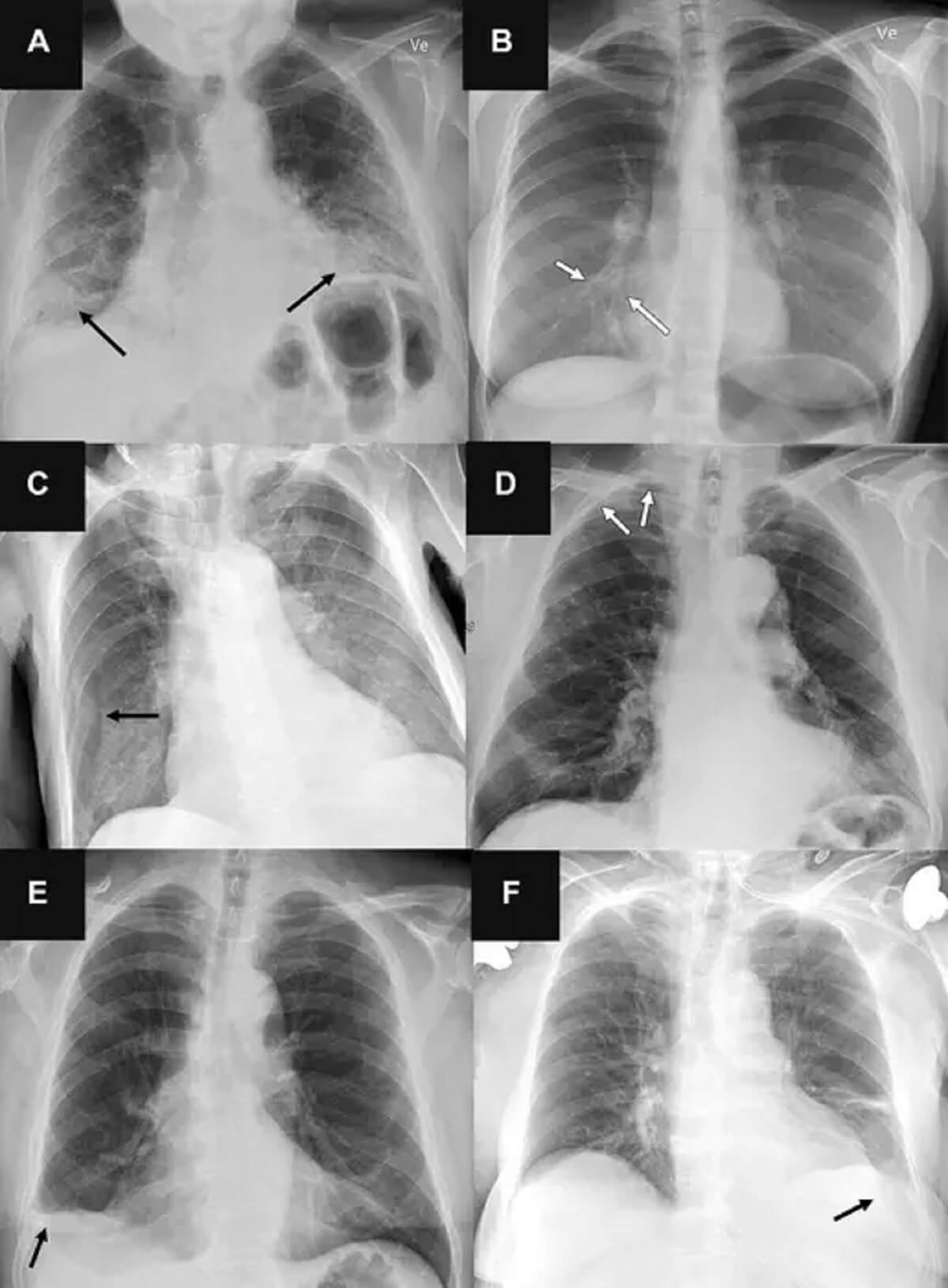 (A) Posteroanterior chest radiograph in a 71-year-old male patient who underwent examination due to progression of dyspnea shows bilateral fibrosis (arrows) (B) Posteroanterior chest radiograph in a 31-year-old female patient referred for radiography due to month-long coughing shows subtle airspace opacity at the right cardiac border (arrows). (C) Anteroposterior chest radiograph in a 78-year-old male patient referred after placement of a central venous catheter shows a skin fold on the right side (arrow). (D) Posteroanterior chest radiograph in a 78-year-old male patient referred to rule out pneumothorax shows very subtle apical right-sided pneumothorax (arrows). (E) Posteroanterior chest radiograph in a 72-year-old male patient referred for radiography without a specified reason shows chronic rounding of the costophrenic angle (arrow). (F) Anteroposterior chest radiograph in a 76-year-old female patient referred for radiography due to suspicion of congestion and/or pneumonia shows a very subtle left-sided pleural effusion (arrow), which was missed by all three AI tools that were capable of analyzing anteroposterior chest radiographs for pleural effusion.
