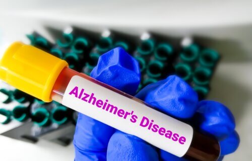 Alzheimer's Disease Blood Test