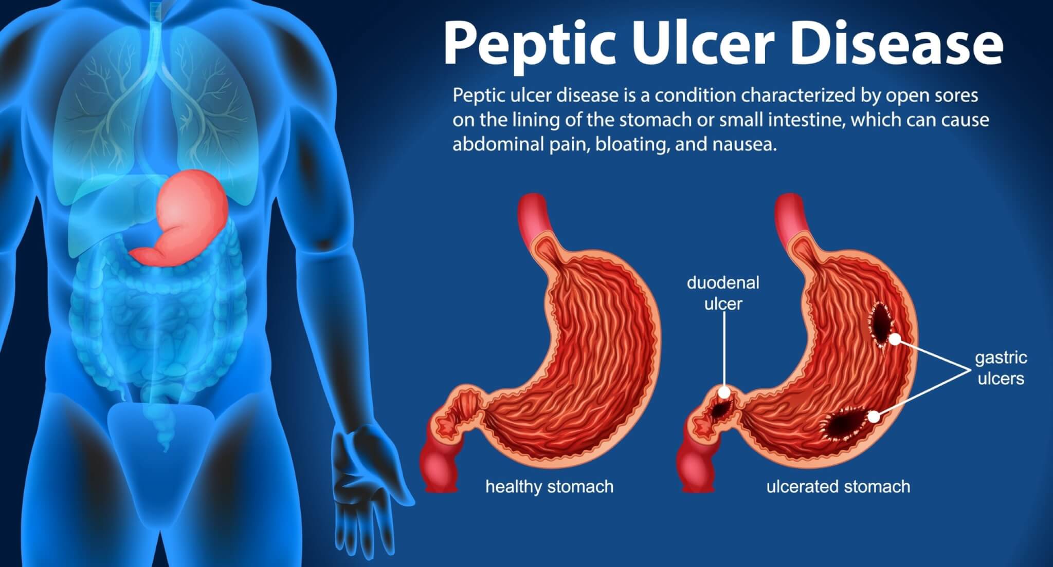 Peptic ulcer disease. 