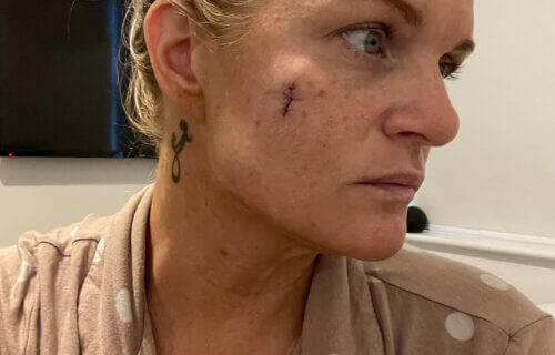 Lisa Costello after having cancerous melanoma on her cheek removed