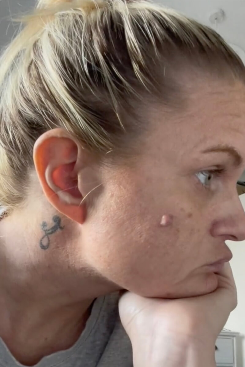 Lisa Costello has had two melanoma skin cancers before the age of 40