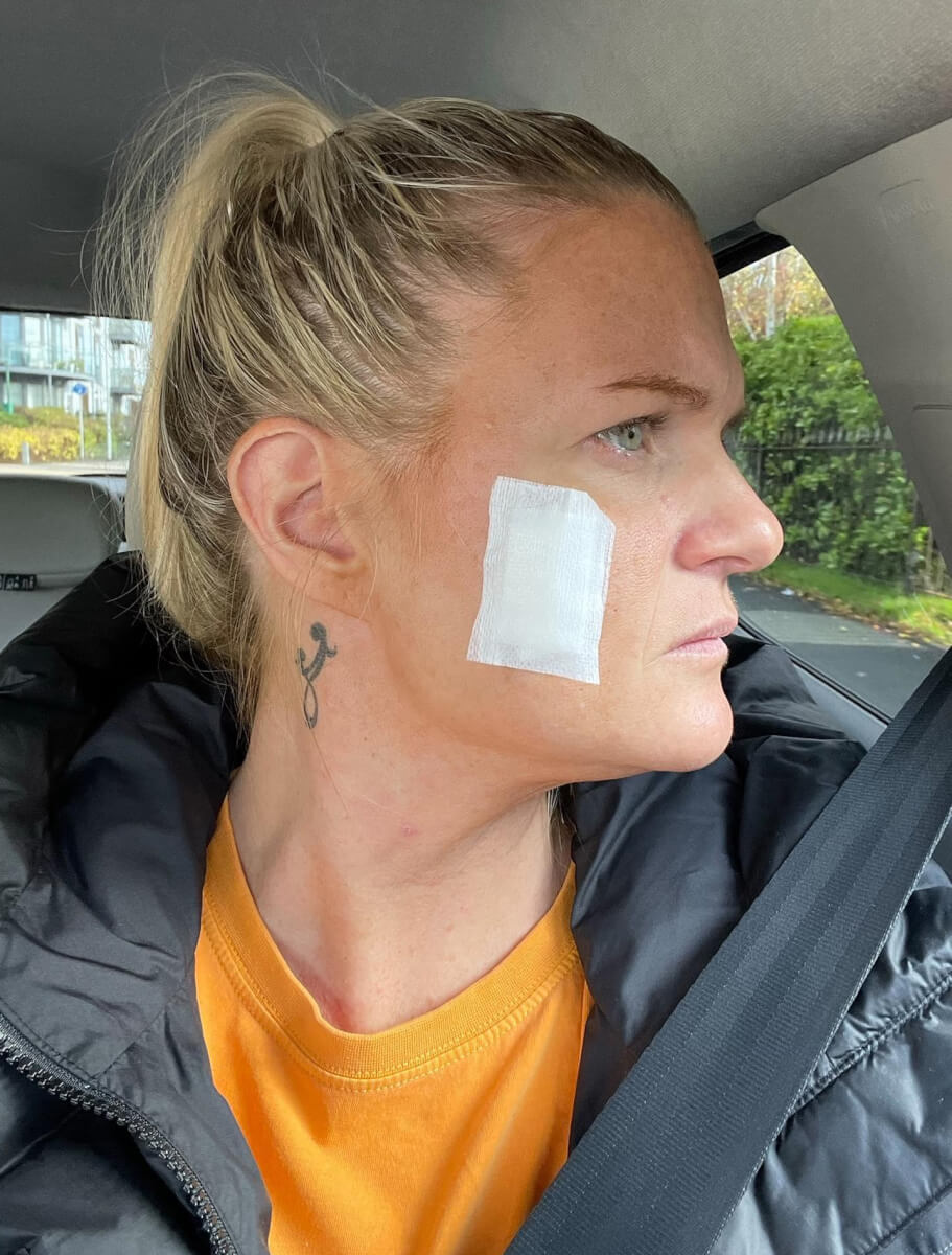 Lisa Costello after having cancerous melanoma on her cheek removed 