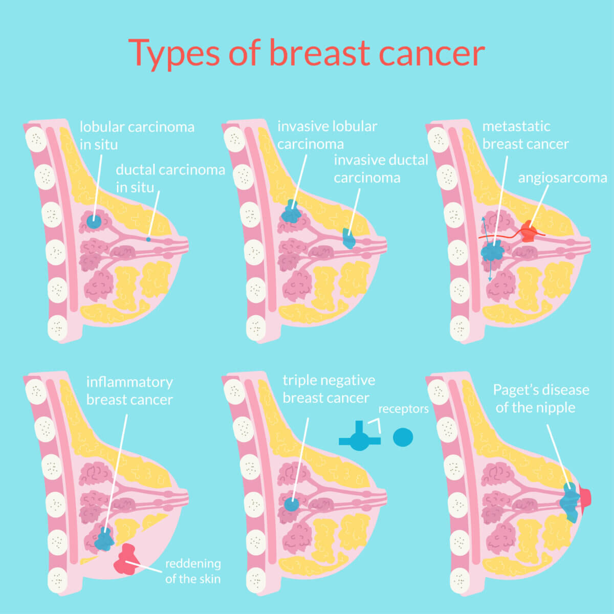 types of breast cancer
