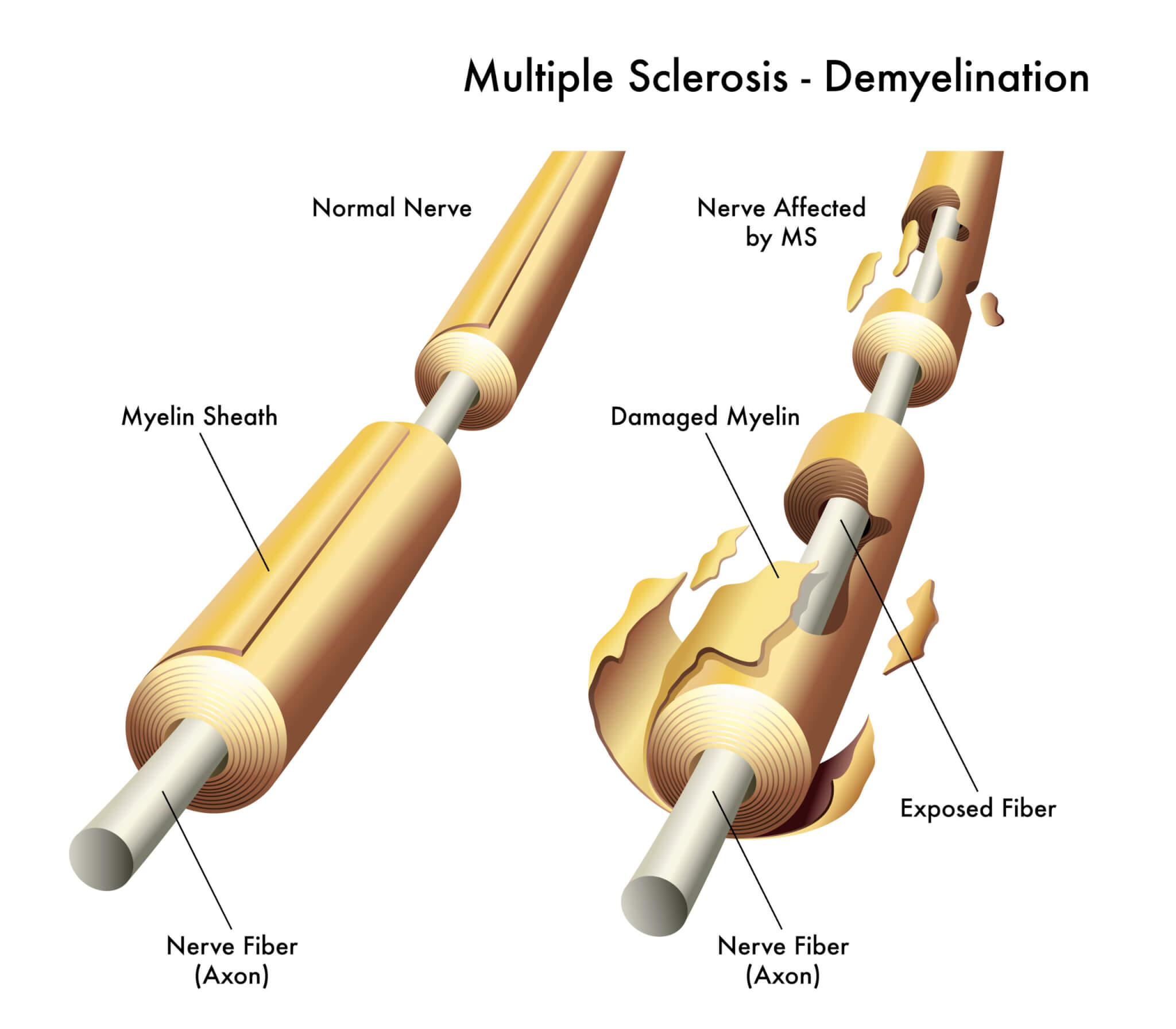 3d medical illustration comparing healthy nerve and one damaged by multiple sclerosis