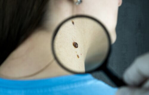 person with magnifying glass examining skin mole