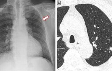 Frontal chest X-ray shows a small nodular opacity (arrow) in the left upper lung zone. Axial, non-contrast, low-dose chest CT scan shows a 9-mm solid nodule (arrow) in the left upper lobe.