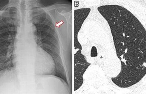 Frontal chest X-ray shows a small nodular opacity (arrow) in the left upper lung zone. Axial, non-contrast, low-dose chest CT scan shows a 9-mm solid nodule (arrow) in the left upper lobe.