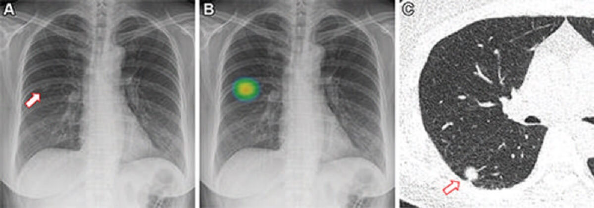 Figure 1. Frontal chest X-ray shows a subtle nodular opacity (arrow) in the right middle lung zone. Axial, non-contrast, low-dose chest CT scan shows a 1.1-cm solid nodule (arrow) in the right lower lobe.