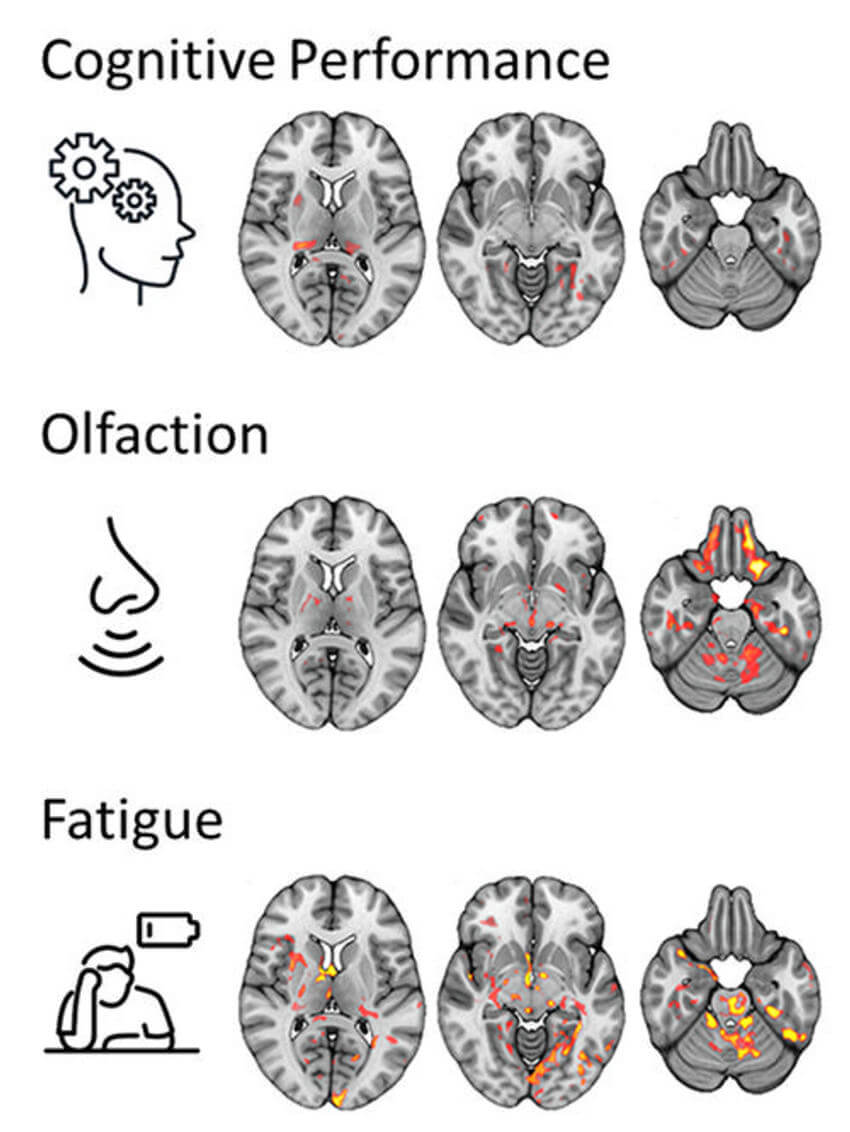 Brain regions in which the microstructure was associated with post-COVID-condition associated symptoms.