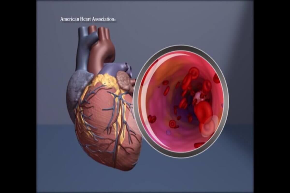 Heart illustration with magnification of the artery