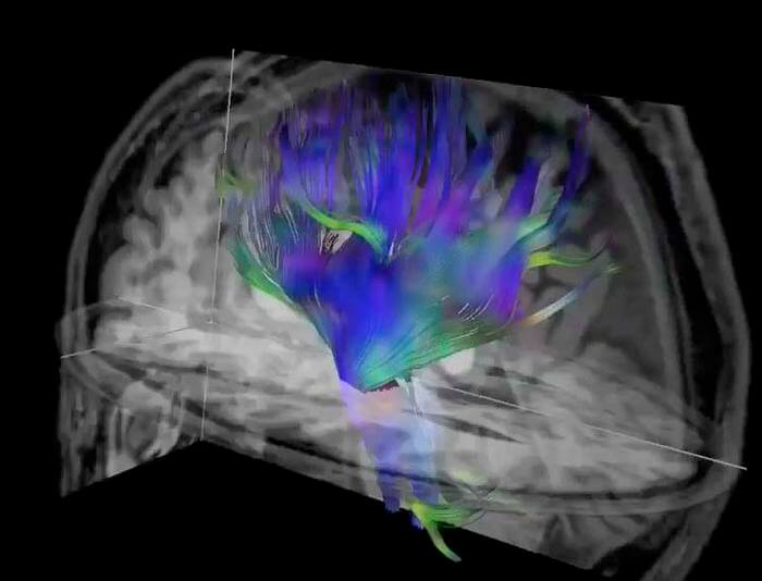 Diffusion tensor imaging, an MRI technique, of the brain. 