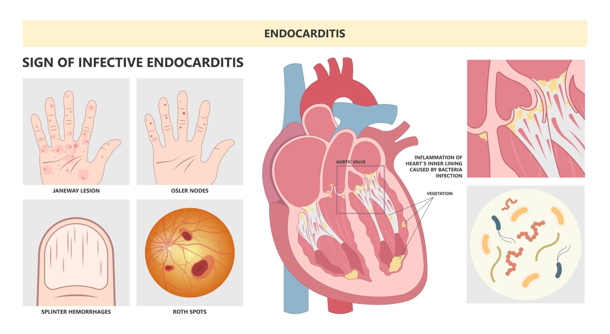 Signs of infective endocarditis