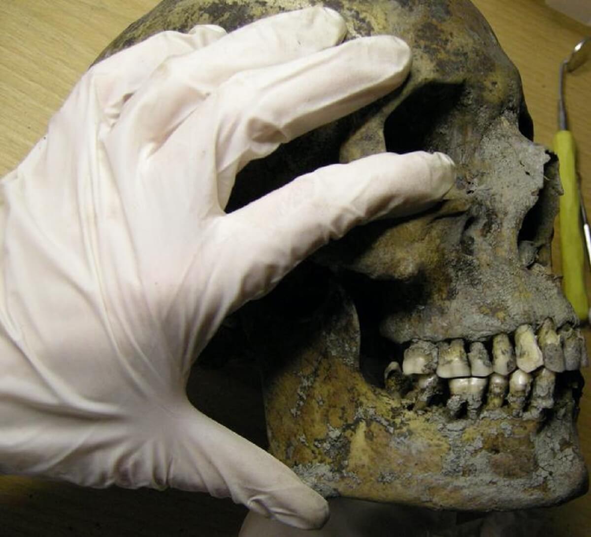 Examination of Viking jaw and teeth.