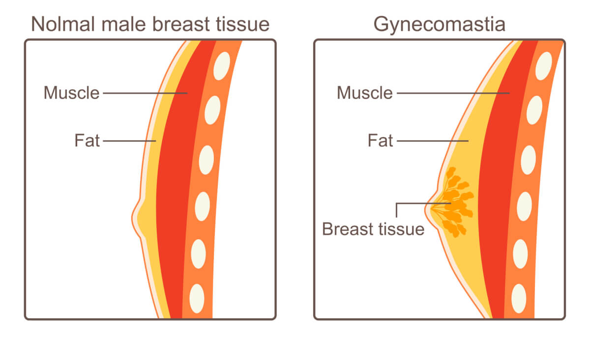 Gynecomastia chart
