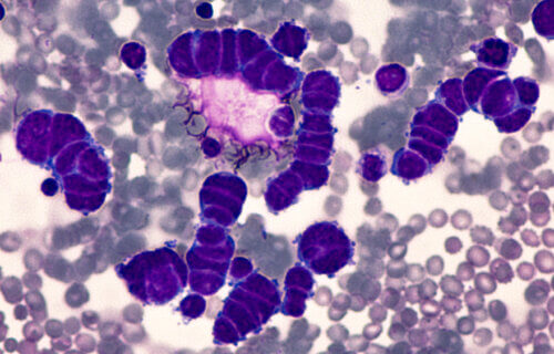 Lung Cancer Awareness: Microscopic image of pleural fluid cytology of a small cell (oat cell) carcinoma from a patient with a history of smoking, demonstrating characteristic nuclear molding.