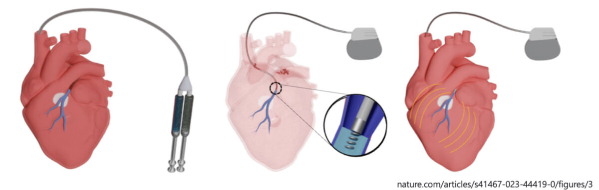 Hydrogel precursors solutions are delivered using a dual lumen catheter to fill coronary veins and tributaries that span the myocardium near the scarred tissue