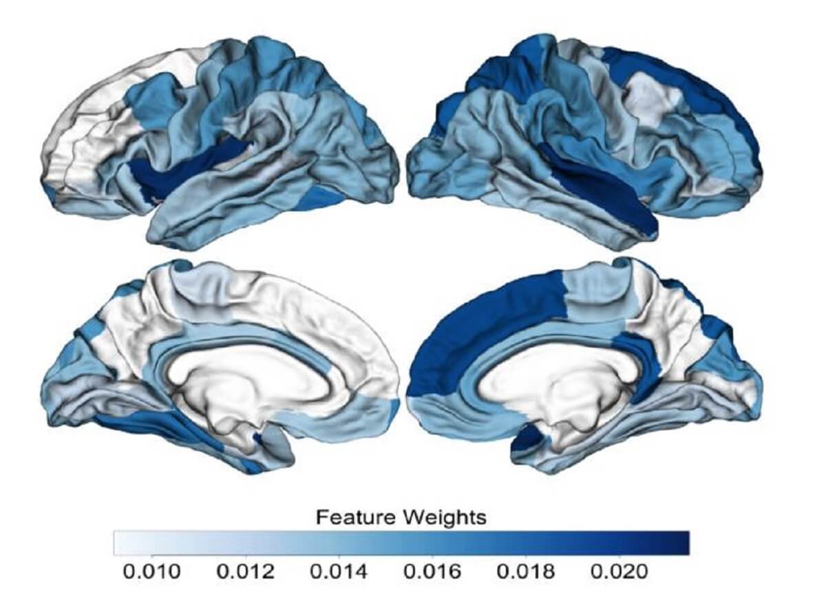 his image illustrates the brain regions in which differences were seen in people at clinical high risk who later developed psychosis. The darker blue areas indicate the more important brain regions for differentiating between the two main groups (healthy and those at clinical high risk who later developed psychosis).