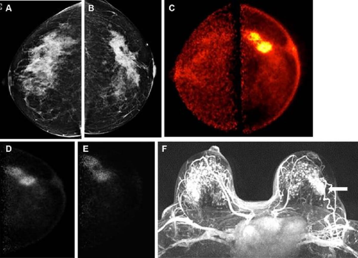 Images obtained in a 50-year-old female patient with a new biopsy-proven malignant lesion in the left breast. (A) Craniocaudal mammogram of the right breast does not show any lesion. (B) The malignant lesion corresponds with a 7.0-cm irregular and spiculated mass on the left craniocaudal mammogram. US-guided core-needle biopsy revealed grade 2 invasive lobular carcinoma. (C) The bilateral positron emission mammographic craniocaudal color image obtained 1 hour after intravenous injection of 185 MBq of fluorine 18–labeled fluorodeoxyglucose (18F-FDG) shows a mass with intense uptake in the left breast with known cancer and no abnormal uptake in the right breast. Positron emission mammographic craniocaudal images of the left breast obtained (D) 1 hour and (E) 4 hours after intravenous injection of 185 MBq of 18F-FDG show no substantial visual difference in uptake of the known cancer. (F) Axial contrast-enhanced fat-saturated subtracted T1-weighted MR image with maximum intensity projection reconstruction obtained 90 seconds after intravenous injection of 0.1 mmol of gadolinium-based contrast material per kilogram of body weight also shows the enhancing mass corresponding to known malignancy (arrow) and marked bilateral background parenchymal enhancement, with multiple nonspecific foci of enhancement in the contralateral breast. The patient opted for bilateral mastectomy, which confirmed left-sided malignancy and no malignancy in the contralateral breast.