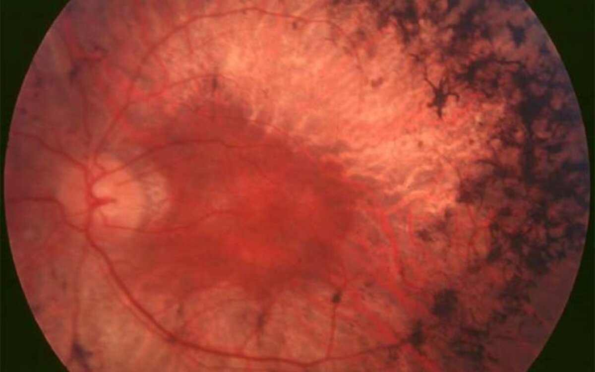 Inherited eye diseases causing blindness may actually start in the gut