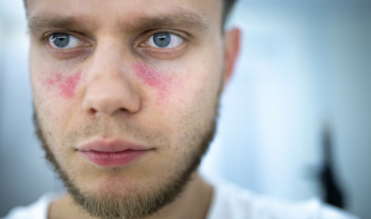 man suffers from systemic lupus erythematosus