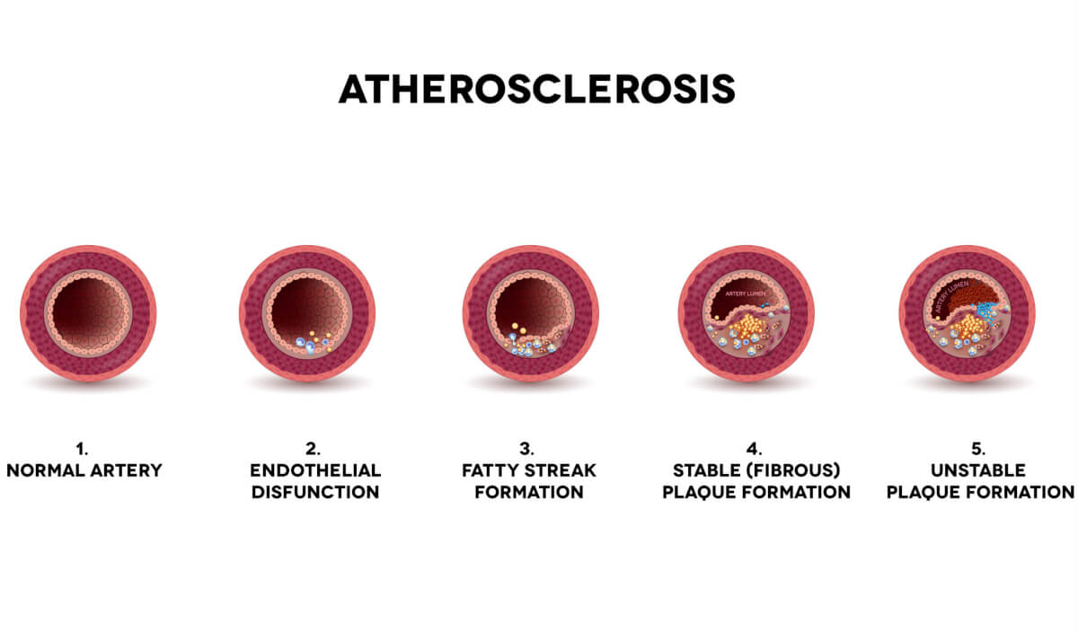 The stages of atherosclerosis illustrated