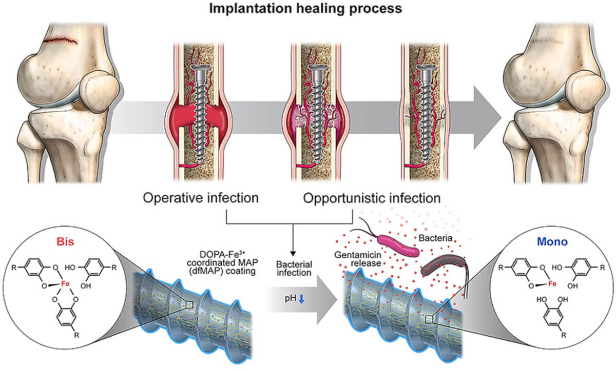 Schematic depicting a functional implant coating material designed to promptly release antibiotics in reaction to alterations in the body's environment induced by bacterial infection