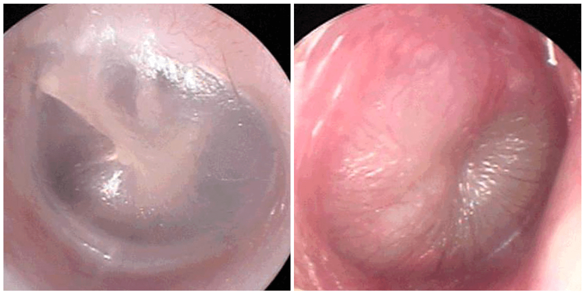 Images of eardrums from a healthy patient (left) or with acute otitis media (right) captured by the new smartphone app