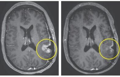 brain cancer tumor scan