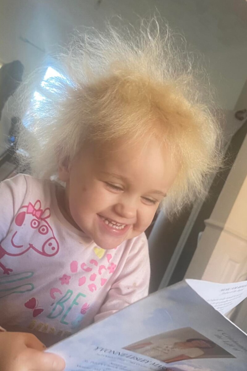uncombable Hair Syndrome 