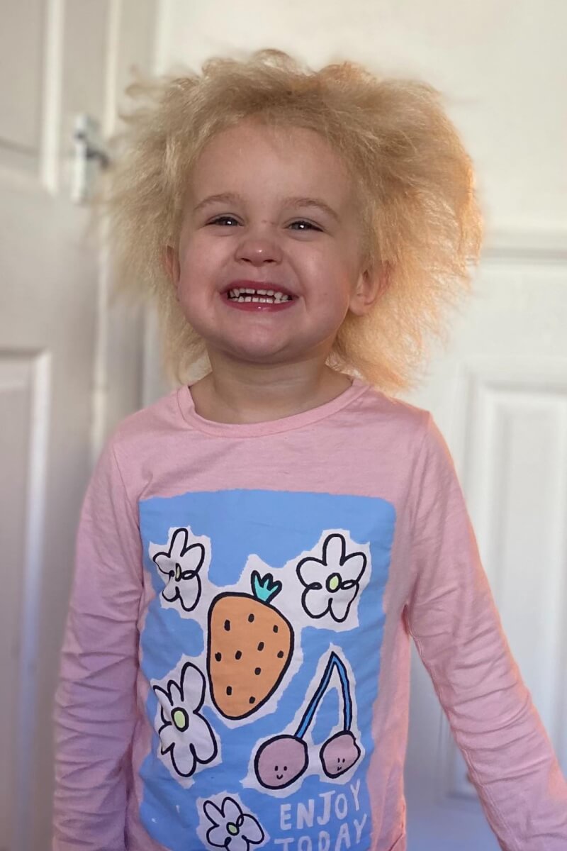 Toddler with uncombable hair syndrome