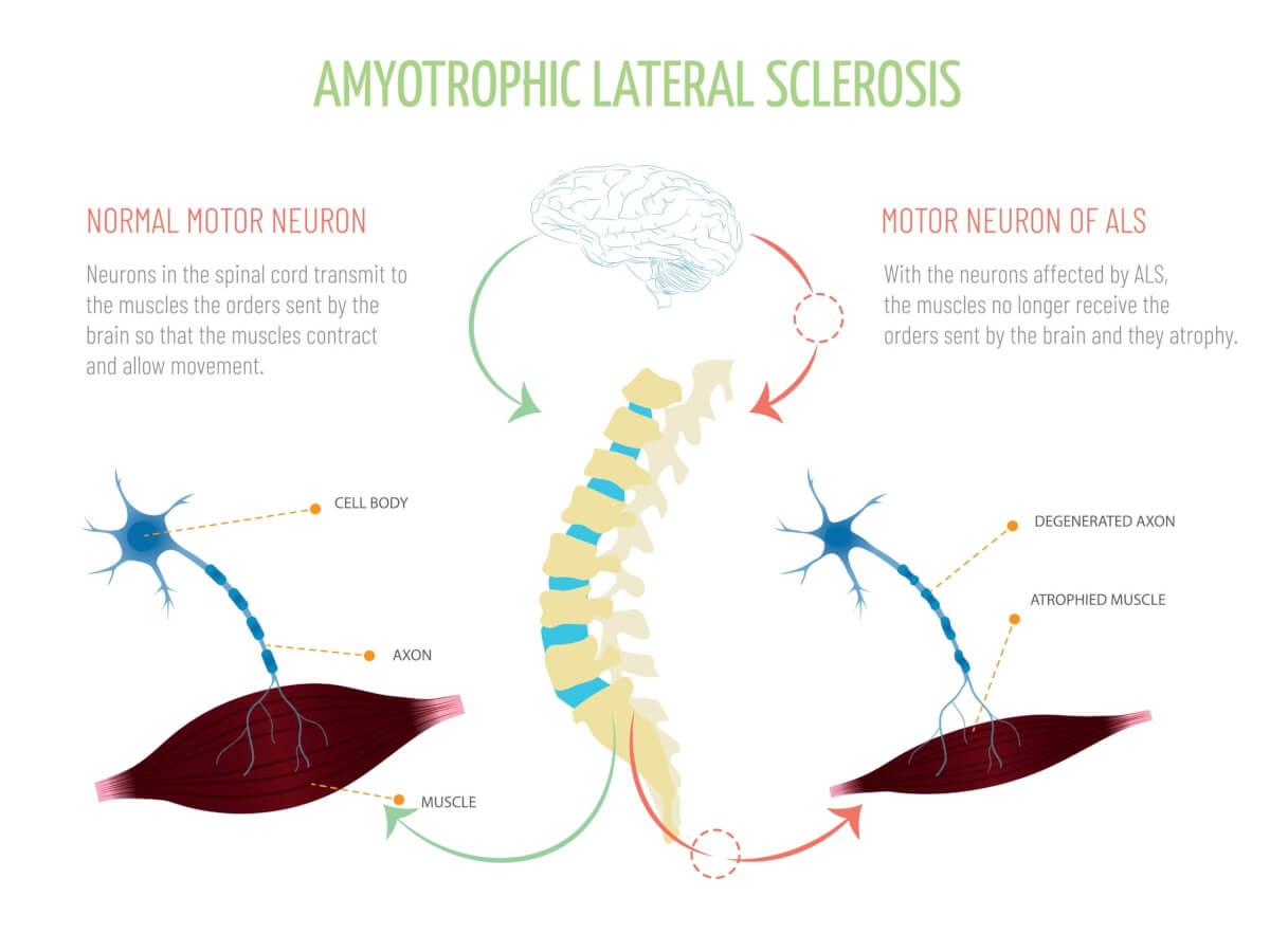 About ALS (Amyotrophic Lateral Sclerosis)