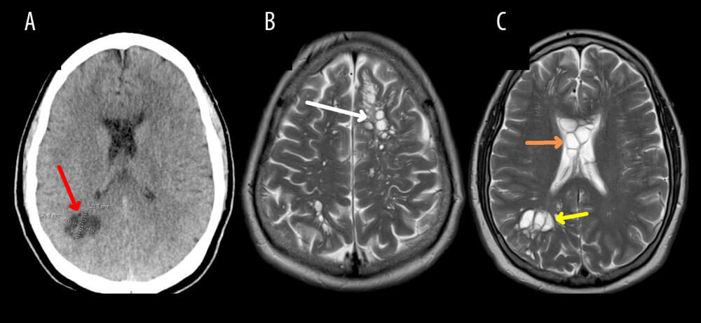 CT scans of brain with parasite in it